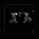 Barium, beam hardening artifacts: CT - Computed tomography
